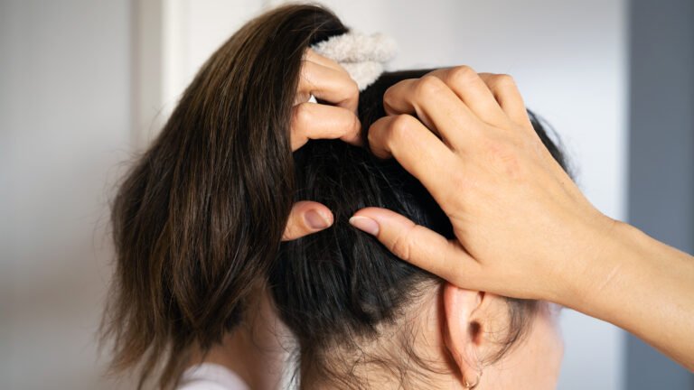 Home Remedies for Dry Scalp